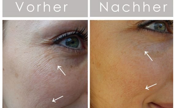 Tierversuchsfreie Gesichtspflege von Beyer & Söhne, die es tatsächlich schafft die Haut enorm zu verbessern! Falten werden reduziert dank Squalan & Hautgel+